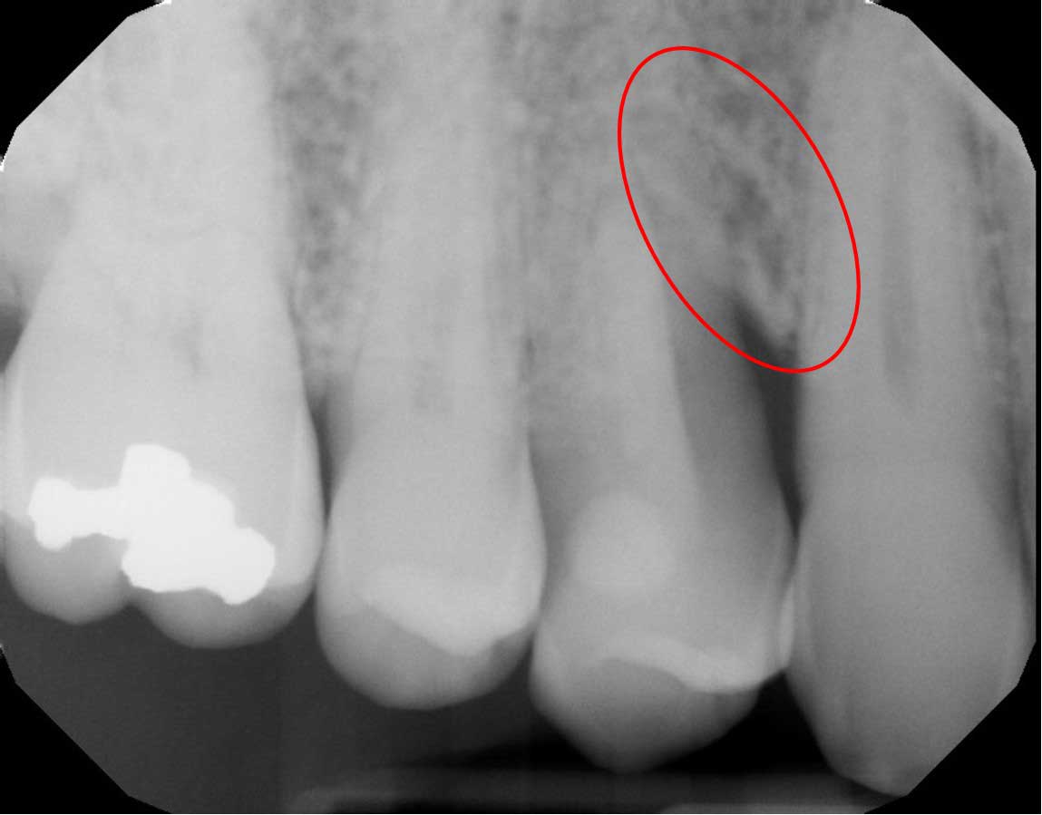 After X-Ray
