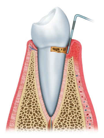 Gingivitis Step 1